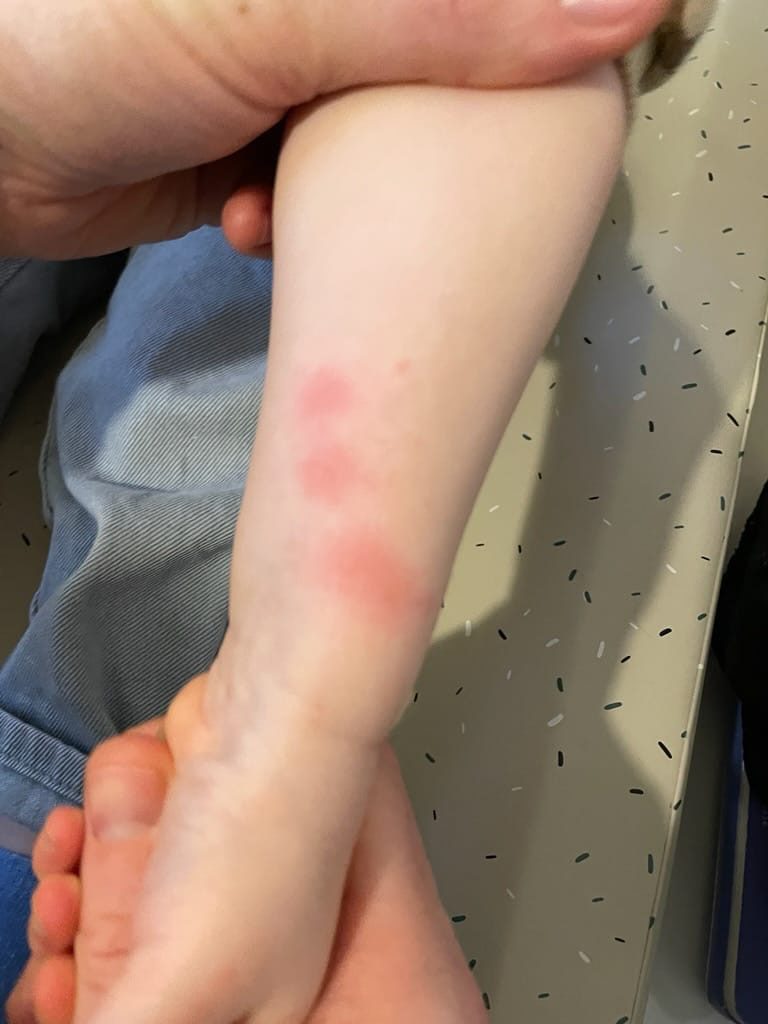 Bouton de punaise de lit