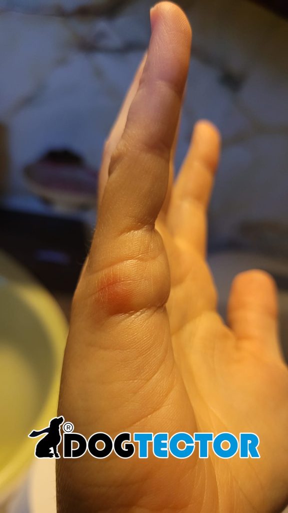 bouton de puce de lit sur la main avec une marque rouge importante.