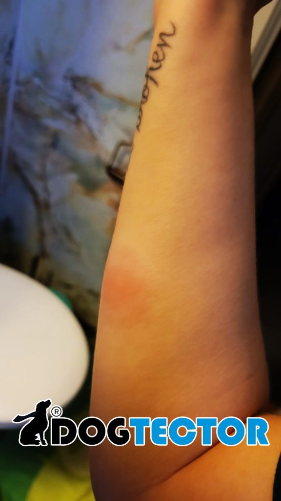 bouton de puce de lit avec plaque rouge après une piqure.