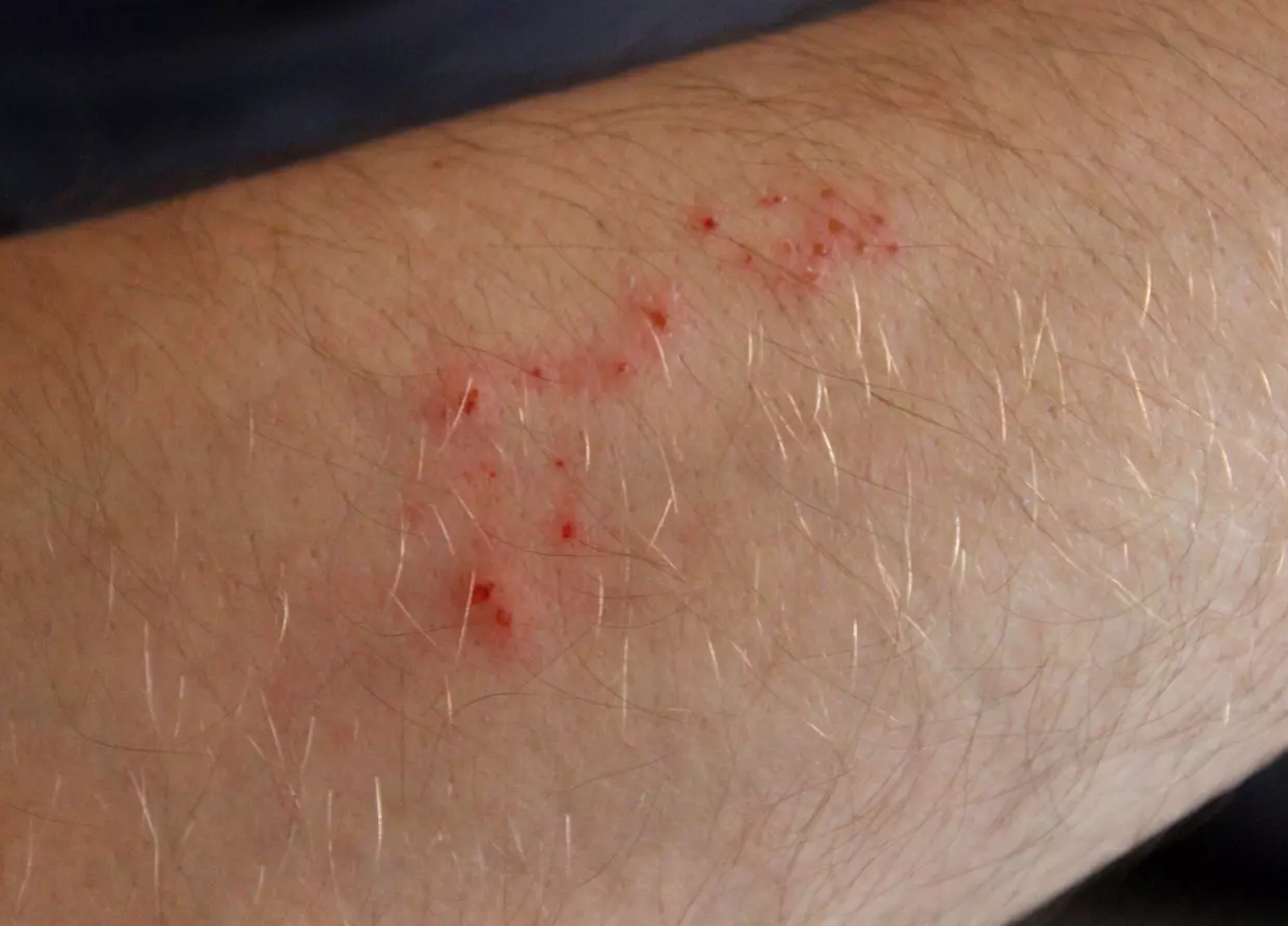 Piqûres rouges en ligne sur un bras, causées par des aoutats.
