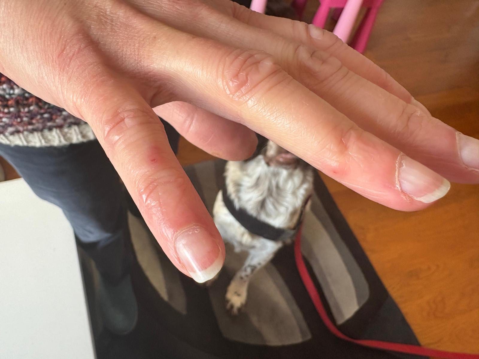 Morsures punaises de lit