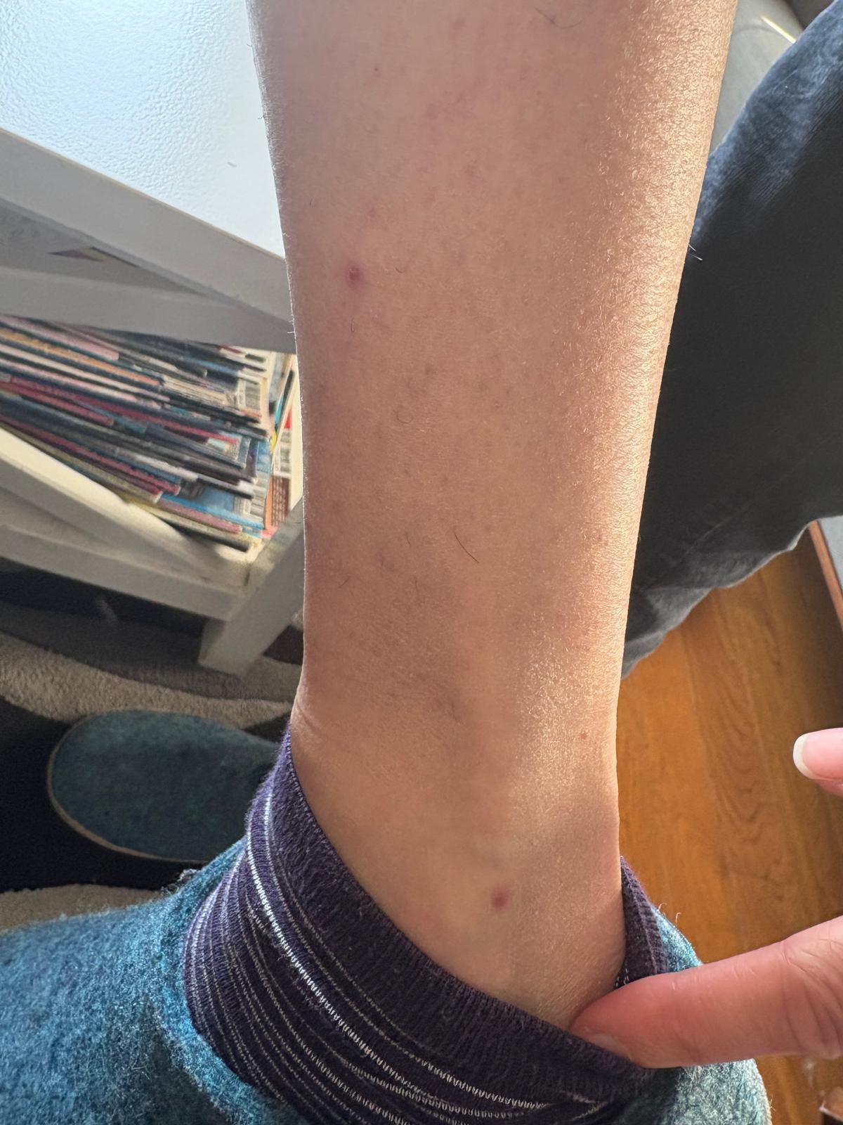 Marques de piqûres sur la jambe, causées par des punaises de lit.
