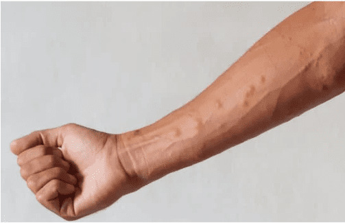 Bras humain présentant des piqûres rouges causées par des punaises de lit.