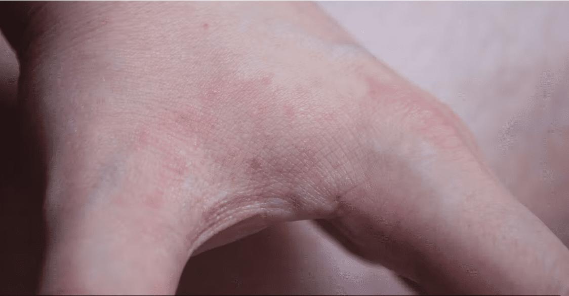 Piqûres de punaises de lit visibles sur la main, causant rougeurs et irritations.