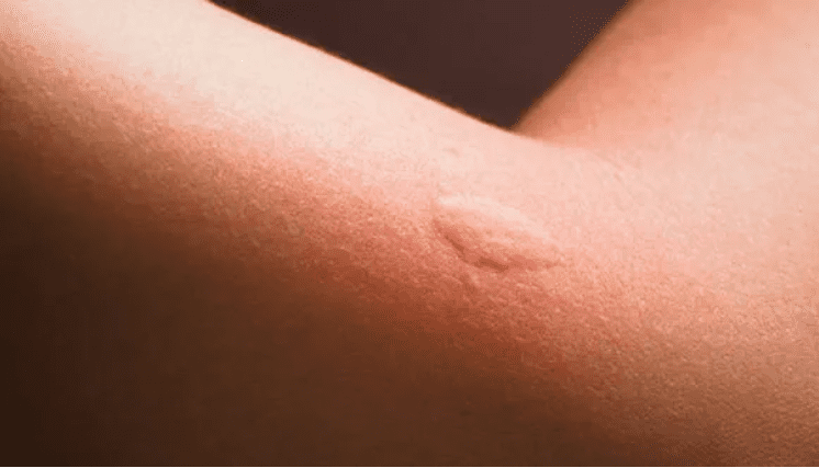 Piqûre de punaise de lit et piqûre de moustique.